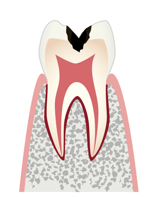象牙質まで進行したむし歯