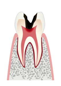 歯髄(神経)まで到達した虫歯