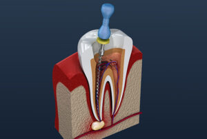 歯内療法(根管治療)